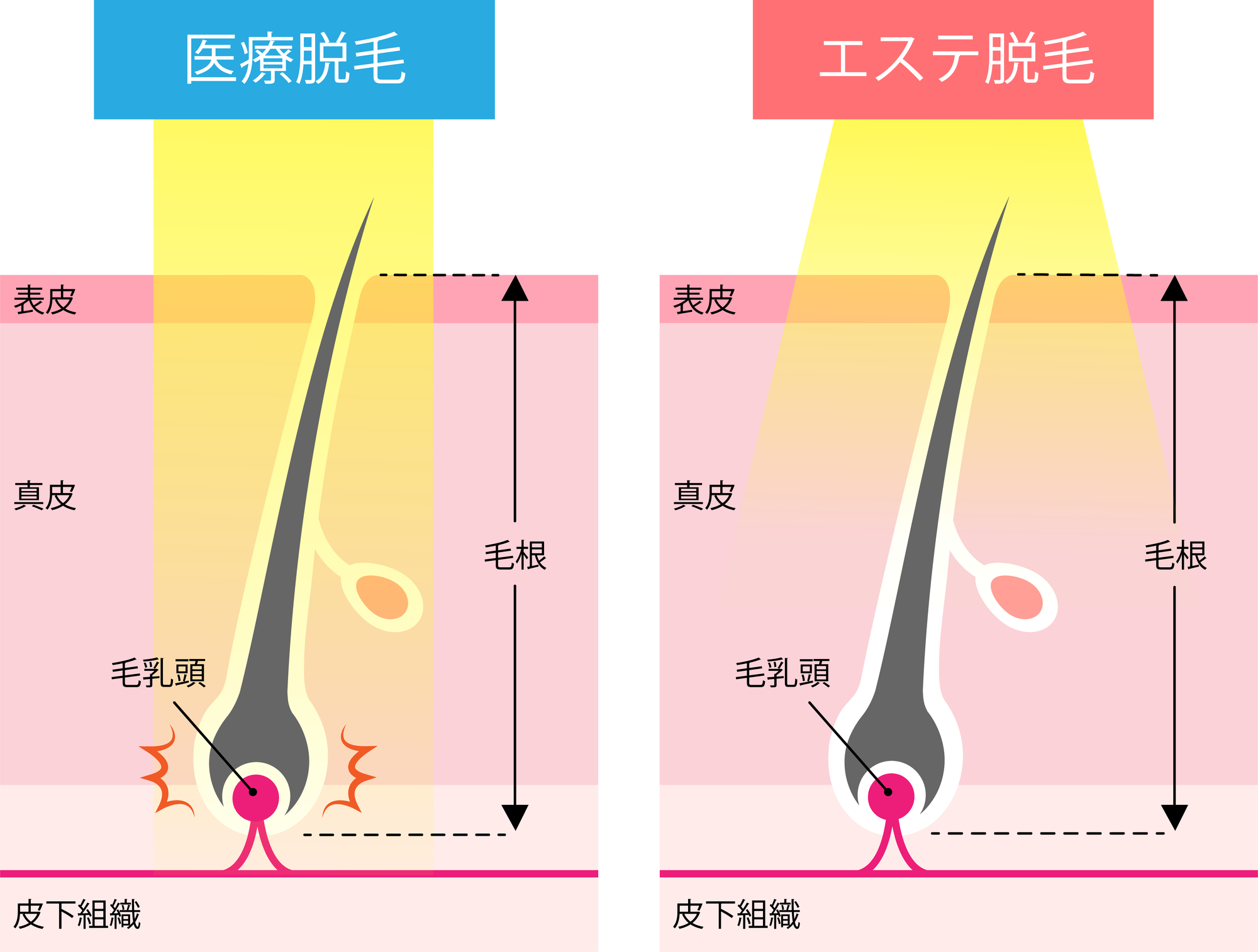 【部位別】医療脱毛は何回で効果が出る？　脱毛効果を感じにくい際の対処法も解説- 医療脱毛ならカノアクリニック