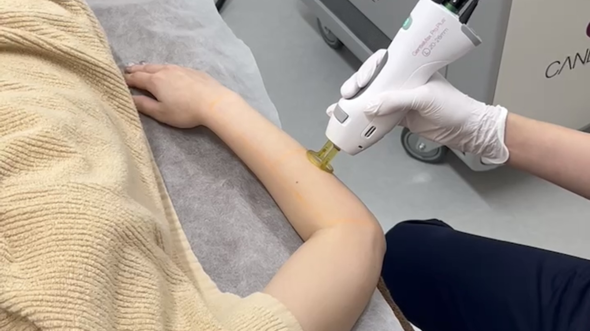 医療脱毛のYAG(ヤグ)レーザーとは?仕組みや搭載機器について解説ー福岡・沖縄の医療脱毛ならKANNO'A.clinic(カノアクリニック)