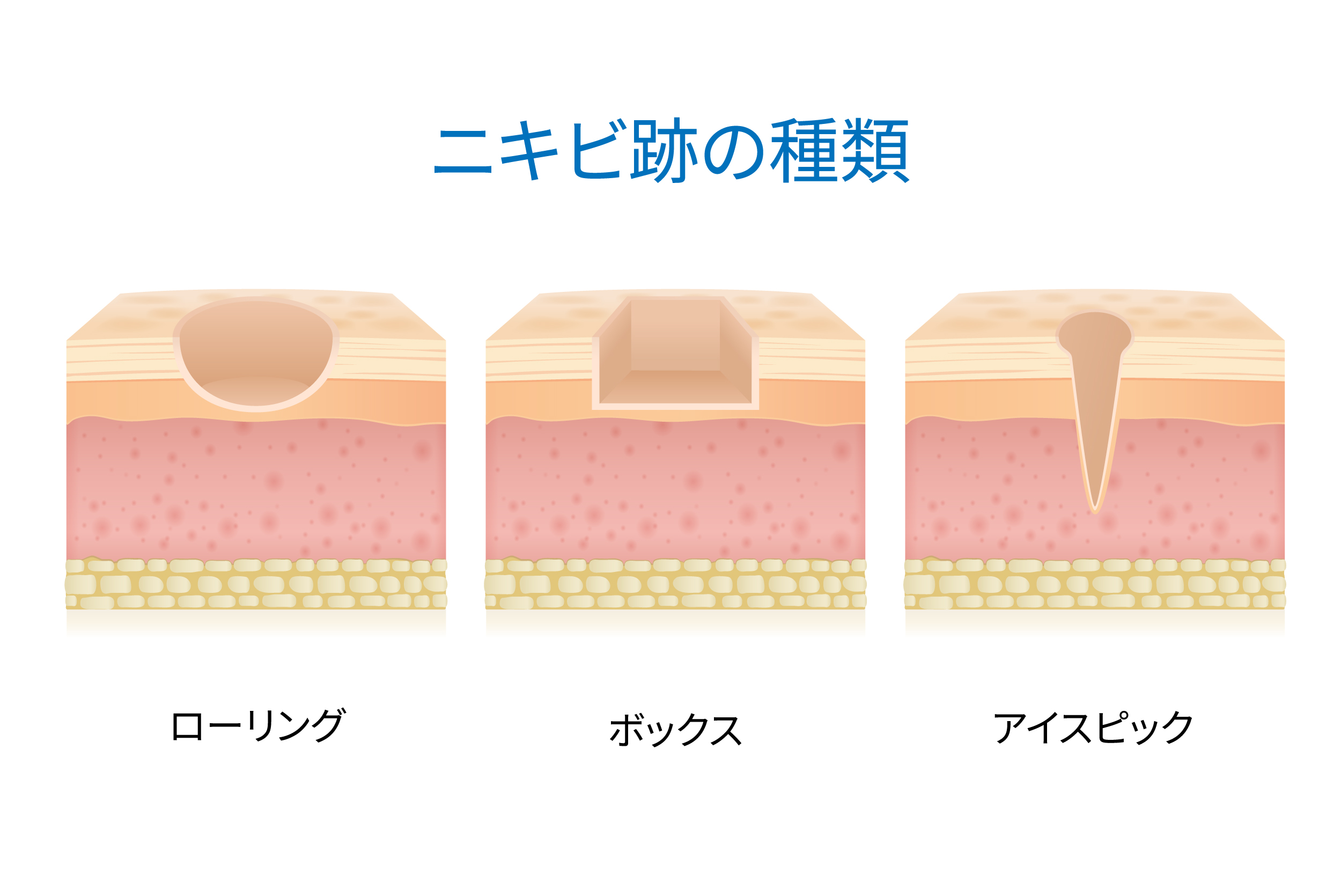 ダーマペンはクレーターに効果絶大?ニキビ跡の凹みを改善する仕組みと回数を徹底解説ー福岡・沖縄の医療脱毛ならKANNO'A.clinic(カノアクリニック)