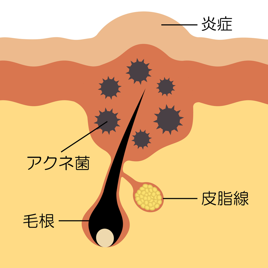 ポテンツァは炎症ニキビに効果ある?治療の仕組み・適応・注意点を徹底解説ー福岡・沖縄の医療脱毛ならKANNO'A.clinic(カノアクリニック)