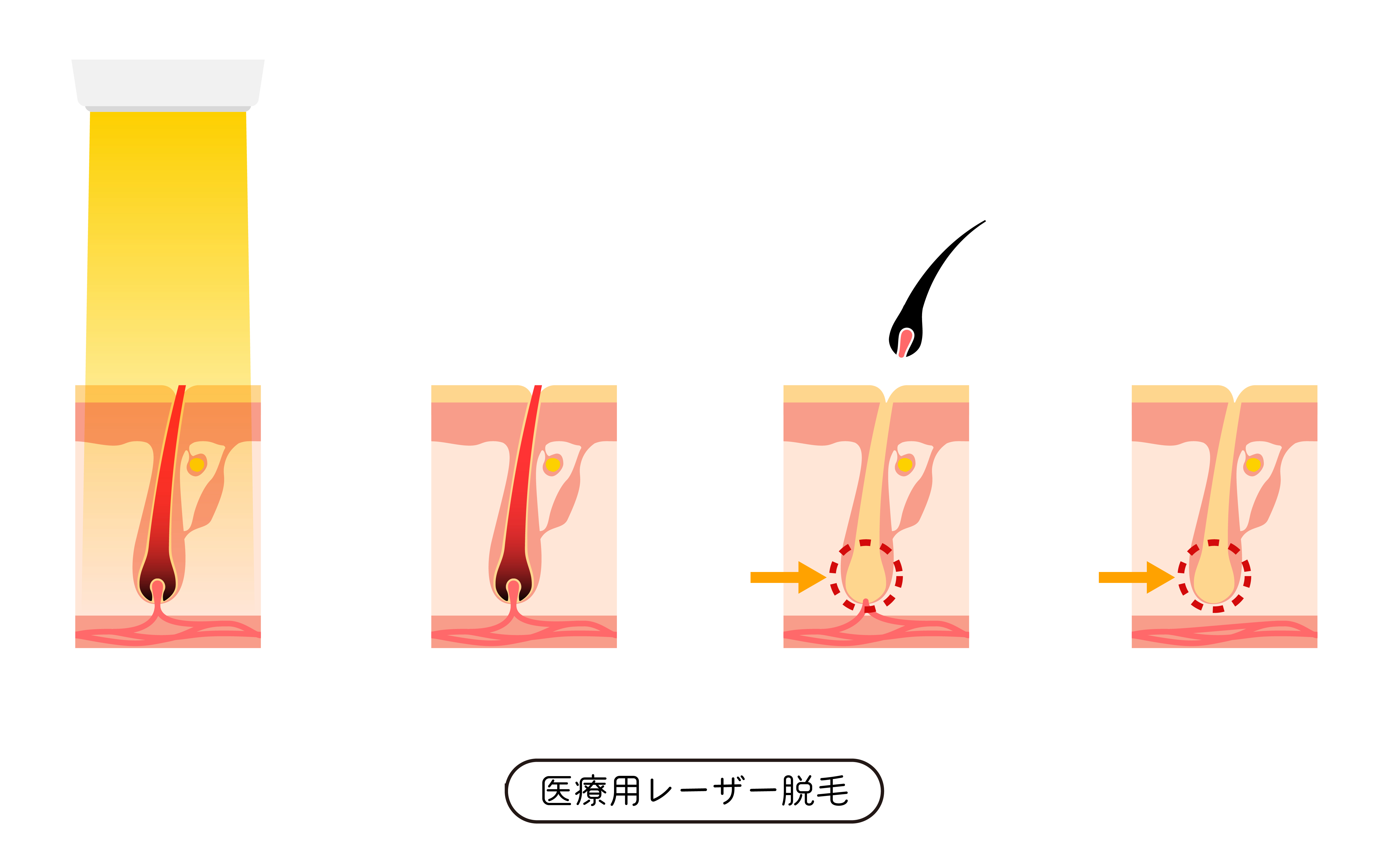 ヤグレーザーは剛毛に効果ある？特徴・痛み・他レーザーとの違いを徹底解説ー福岡・沖縄の医療脱毛ならKANNO'A.clinic(カノアクリニック)