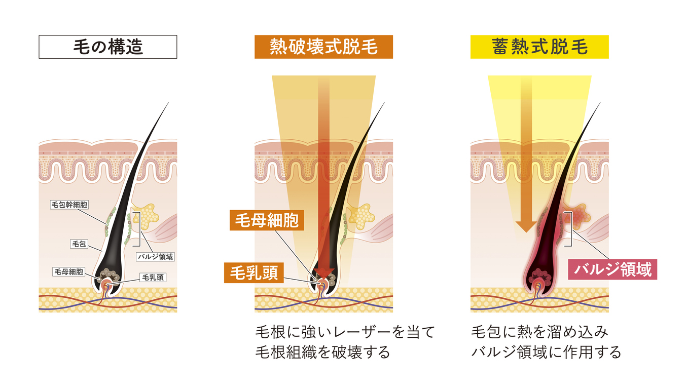 熱破壊式と蓄熱式の違いとは？効果・痛み・向いている人を徹底比較ー福岡・沖縄の医療脱毛ならKANNO'A.clinic(カノアクリニック)